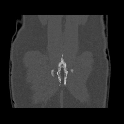 Chondrosarcoma of iliac wing (Radiopaedia 63861-72599 Coronal bone window 103).jpg