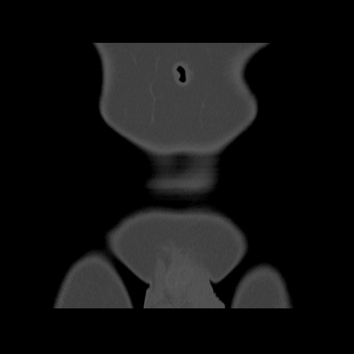 File:Chondrosarcoma of iliac wing (Radiopaedia 63861-72599 Coronal bone window 15).jpg