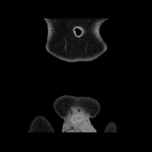 File:Chondrosarcoma of iliac wing (Radiopaedia 63861-72599 Coronal non-contrast 14).jpg