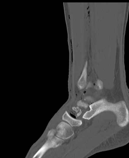 Chopart fracture (Radiopaedia 35347-36851 Sagittal bone window 38).jpg