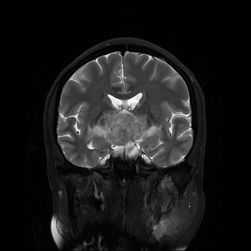 File:Chordoid glioma of third ventricle (Radiopaedia 91612-109340 Coronal T2 14).jpg