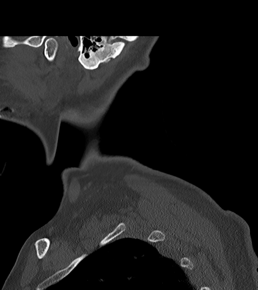 File:Chordoma (C4 vertebra) (Radiopaedia 47561-52188 Sagittal bone window 2).png