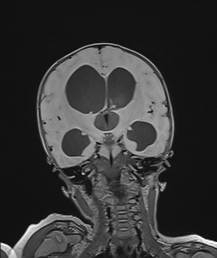 File:Choroid plexus papilloma (Radiopaedia 84612-100019 Coronal FLAIR 65).jpg