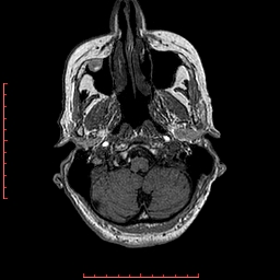 File:Choroid plexus xanthogranuloma (Radiopaedia 67843-77270 Axial T1 140).jpg