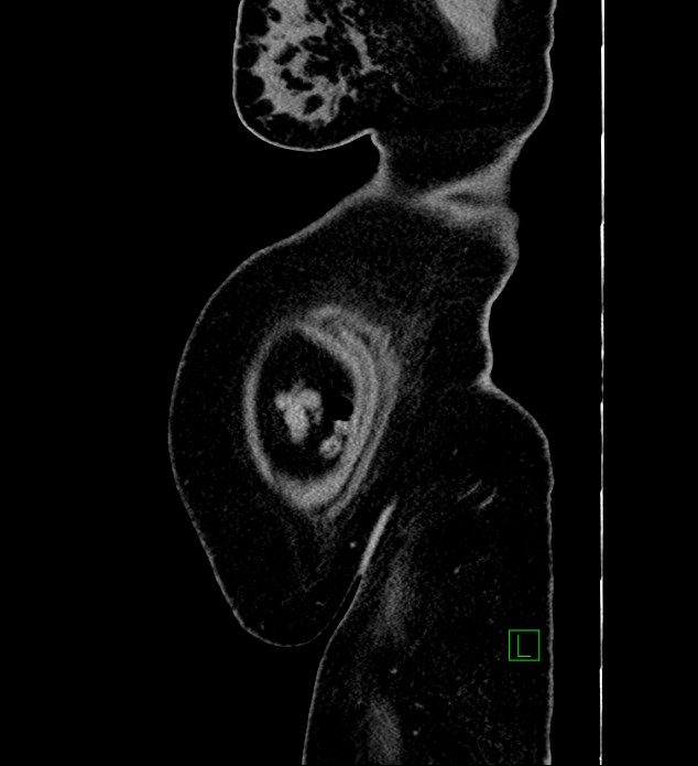 Chromophobe renal cell carcinoma (Radiopaedia 84239-99519 G 5).jpg