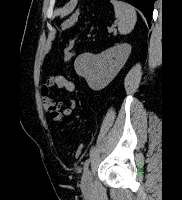 Chromophobe renal cell carcinoma (Radiopaedia 84286-99573 C 41).jpg