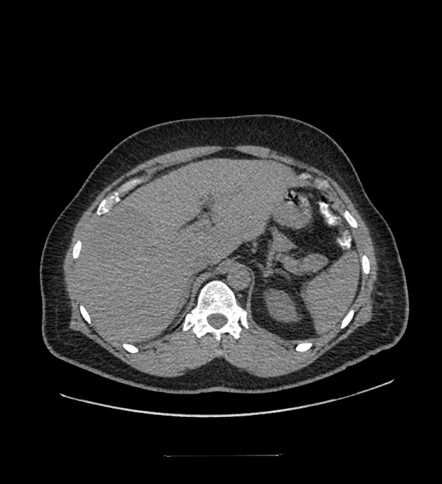 Chromophobe renal cell carcinoma (Radiopaedia 84337-99644 Axial non-contrast 22).jpg