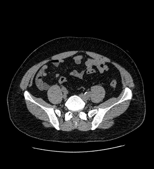 Chromophobe renal cell carcinoma (Radiopaedia 84337-99693 Axial non-contrast 112).jpg