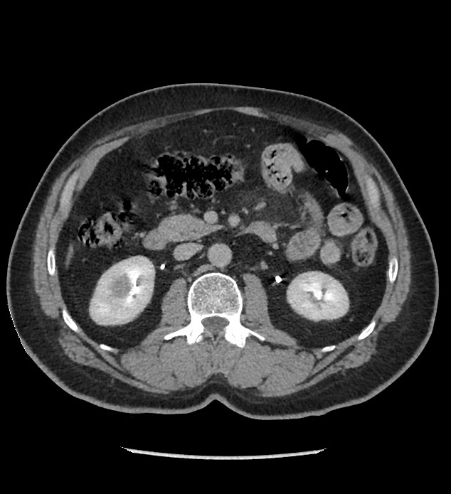 Chromophobe renal cell carcinoma (Radiopaedia 86879-103083 D 62).jpg
