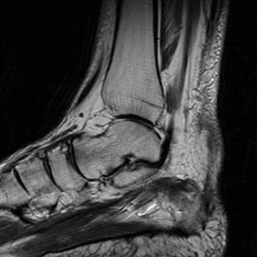 File:Chronic Achilles tendon rupture (Radiopaedia 15262-15100 Sagittal T2 9).jpg