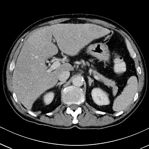 Chronic appendicitis complicated by appendicular abscess, pylephlebitis and liver abscess (Radiopaedia 54483-60700 B 48).jpg