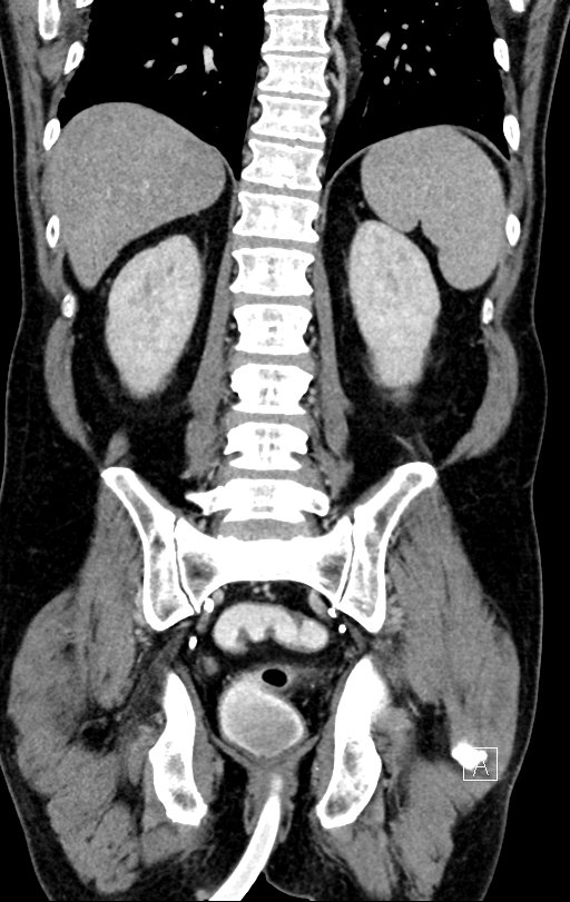 Chronic appendicitis complicated by appendicular abscess, pylephlebitis and liver abscess (Radiopaedia 54483-60700 C 60).jpg
