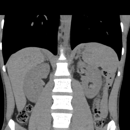 File:Chronic calcific pancreatitis (Radiopaedia 56280-62953 Coronal non-contrast 21).jpg