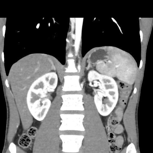 File:Chronic calcific pancreatitis (Radiopaedia 56280-62953 E 20).jpg
