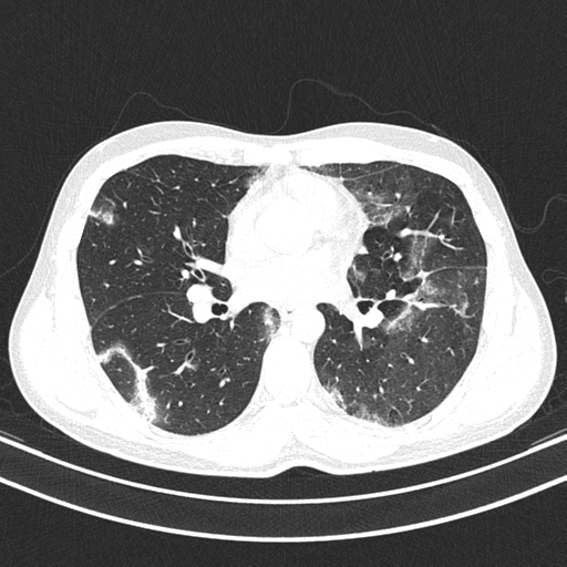 File:Chronic eosinophilic pneumonia (Radiopaedia 39331-41587 Axial lung window 28).png