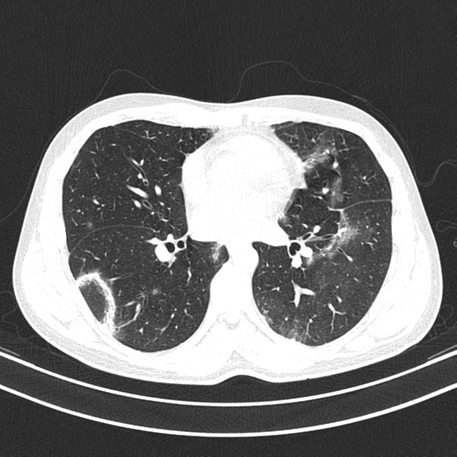 Chronic eosinophilic pneumonia (Radiopaedia 39331-41587 Axial lung window 30).png