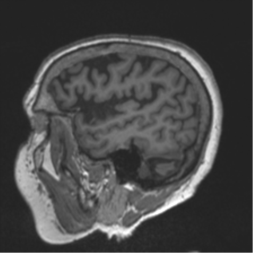 Chronic hypertensive encephalopathy (Radiopaedia 39993-42482 Sagittal T1 23).png