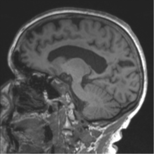 File:Chronic hypertensive encephalopathy (Radiopaedia 39993-42482 Sagittal T1 55).png