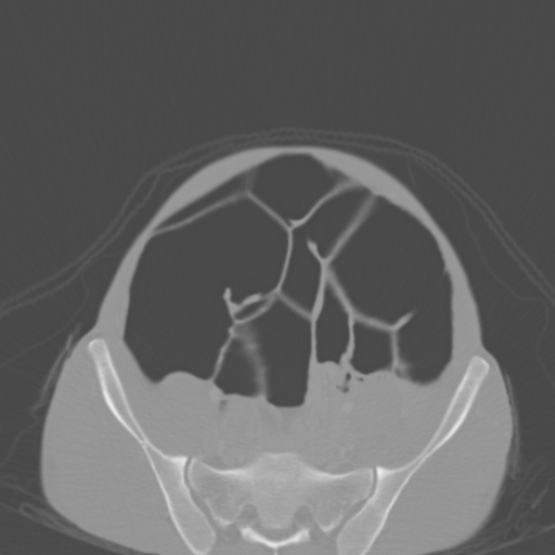 Chronic large bowel pseudo-obstruction (Radiopaedia 43181-46492 Axial bone window 132).jpg