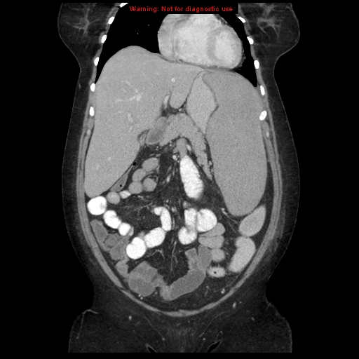 File:Chronic myeloid leukemia with splenic infarction (Radiopaedia 9178-9874 E 16).jpg