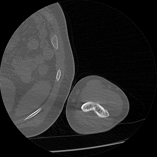 Chronic osteomyelitis (Radiopaedia 67597-76998 Axial bone window 65).jpg