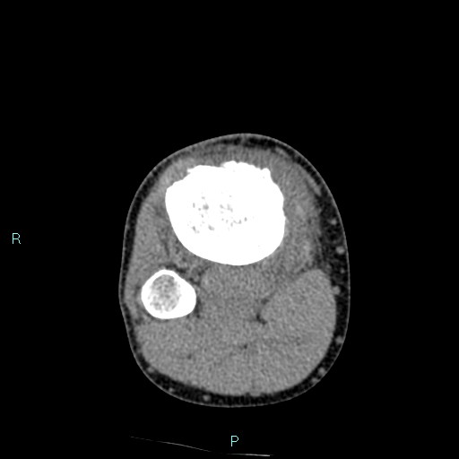 Chronic osteomyelitis (with Brodie abscess) (Radiopaedia 76405-88111 A 74).jpg