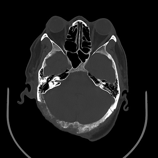 Chronic osteomyelitis - calvarial (severe) (Radiopaedia 69668-79616 Axial bone window 34).jpg