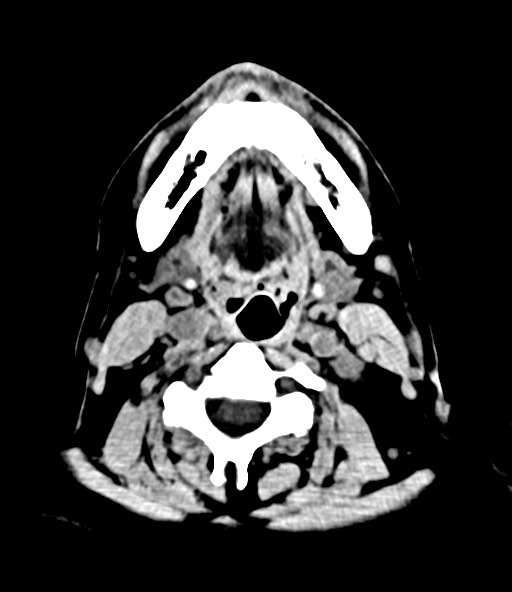 File:Chronic osteomyelitis - calvarial (severe) (Radiopaedia 69668-79616 Axial non-contrast 3).jpg