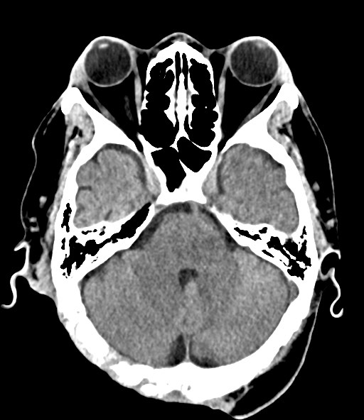 File:Chronic osteomyelitis - calvarial (severe) (Radiopaedia 69668-79616 Axial non-contrast 35).jpg