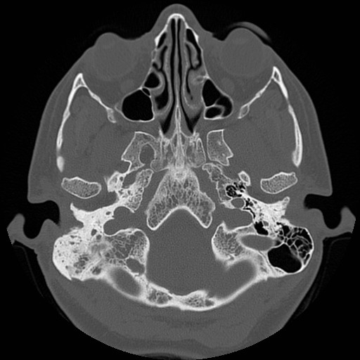 File:Chronic otomastoiditis (Radiopaedia 27138-27309 Axial bone window 13).jpg
