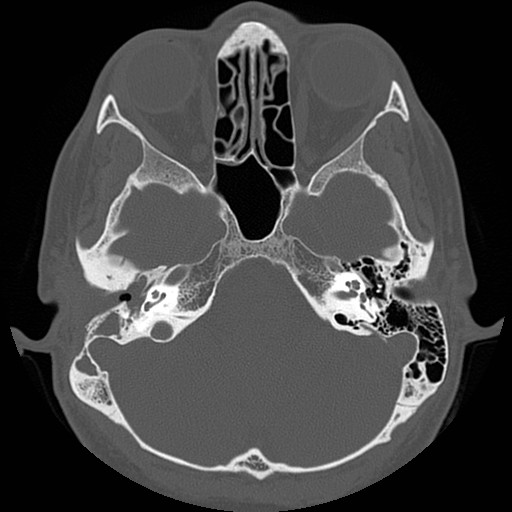 File:Chronic otomastoiditis (Radiopaedia 27138-27309 Axial bone window 31).jpg