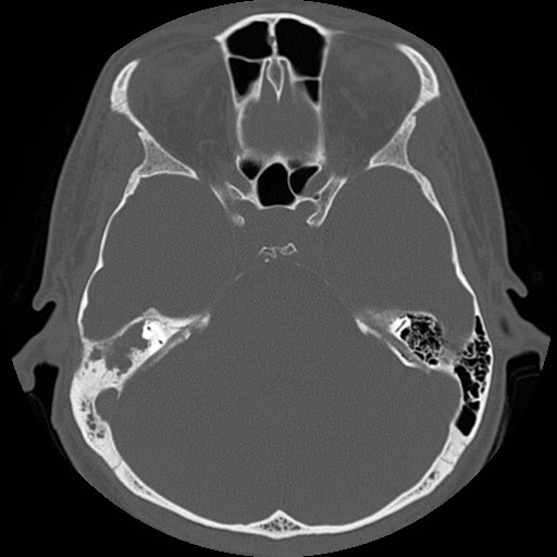 File:Chronic otomastoiditis (Radiopaedia 27138-27309 Axial bone window 46).jpg