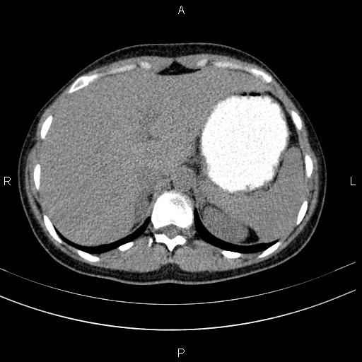 Chronic pancreatitis (Radiopaedia 64576-73450 Axial non-contrast 24).jpg