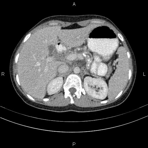File:Chronic pancreatitis (Radiopaedia 64576-73450 C 37).jpg