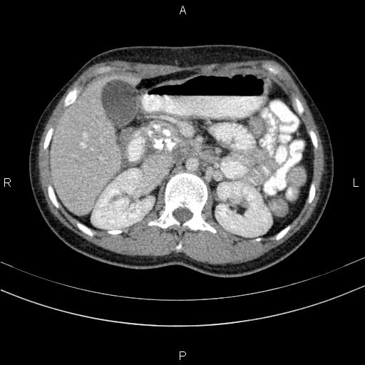 Chronic pancreatitis (Radiopaedia 64576-73450 C 54).jpg