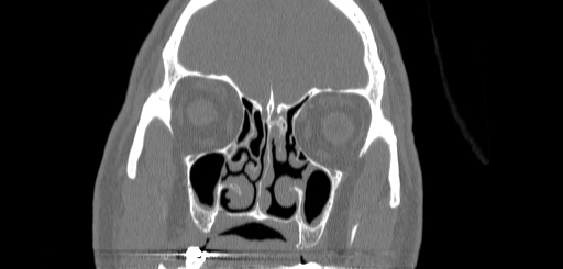 Chronic sphenoidal sinusitis (Radiopaedia 62030-70122 Coronal bone window 58).jpg