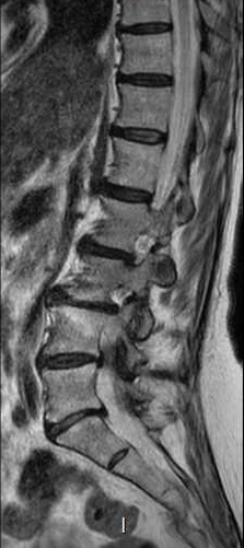 File:Chronic spinal hematoma with cauda equina syndrome (Radiopaedia 75745-87090 Sagittal T2 9).png
