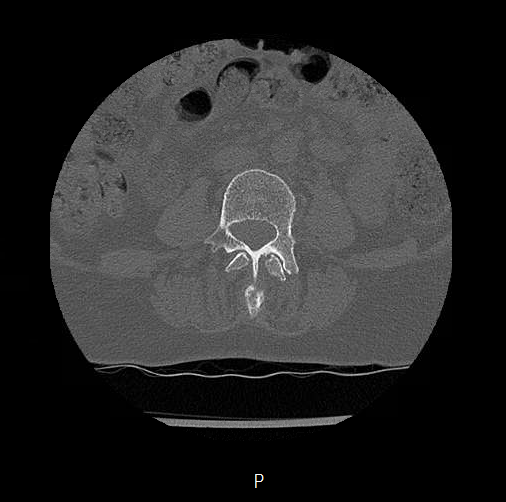 Chronic spinal hematoma with cauda equina syndrome (Radiopaedia 75745-88197 Axial bone window 22).png