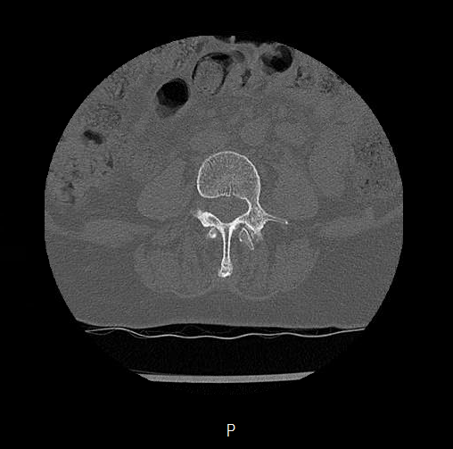Chronic spinal hematoma with cauda equina syndrome (Radiopaedia 75745-88197 Axial bone window 26).png