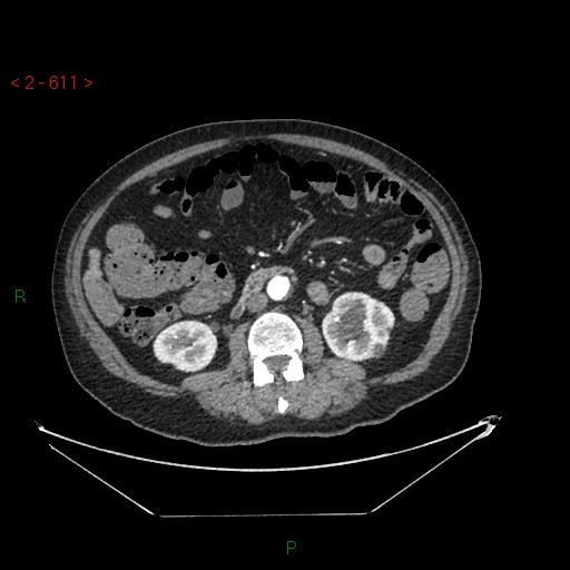 File:Circumaortic left renal vein and doubled left renal arteries (Radiopaedia 52268-58158 A 147).jpg