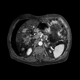 Cirrhosis and hepatocellular carcinoma in the setting of hemochromatosis (Radiopaedia 75394-86594 Axial T1 C+ fat sat 214).jpg