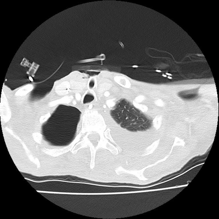 Clagett thoracotomy with bronchopleural fistula (Radiopaedia 29192-29587 Axial lung window 3).jpg