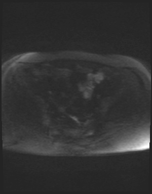 File:Class II Mullerian duct anomaly- unicornuate uterus with rudimentary horn and non-communicating cavity (Radiopaedia 39441-41755 Axial DWI 75).jpg