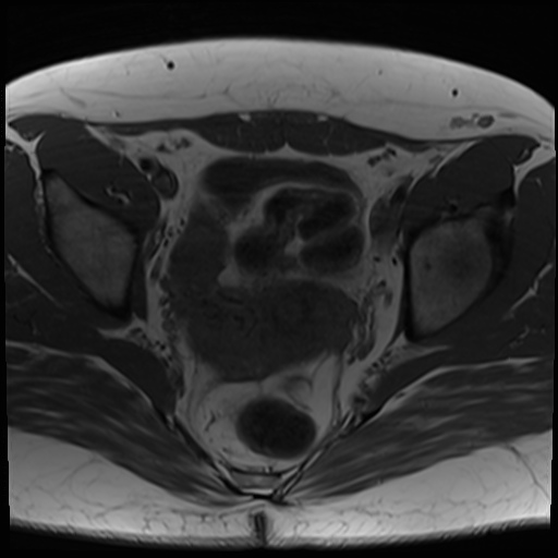 File:Class II Mullerian duct anomaly- unicornuate uterus with rudimentary horn and non-communicating cavity (Radiopaedia 39441-41755 Axial T1 17).jpg