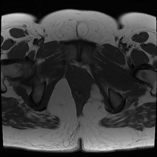 File:Class II Mullerian duct anomaly- unicornuate uterus with rudimentary horn and non-communicating cavity (Radiopaedia 39441-41755 Axial T1 26).jpg