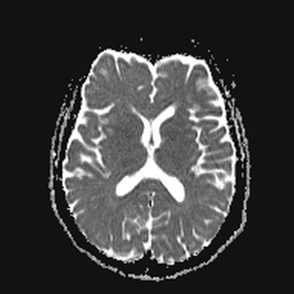 File:Clival meningioma (Radiopaedia 53278-59248 Axial ADC 14).jpg