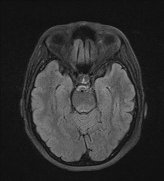 File:Clival meningioma (Radiopaedia 53278-59248 Axial FLAIR 9).jpg