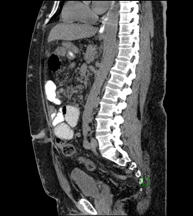 Closed-loop small bowel obstruction-internal hernia (Radiopaedia 78439-91096 C 72).jpg