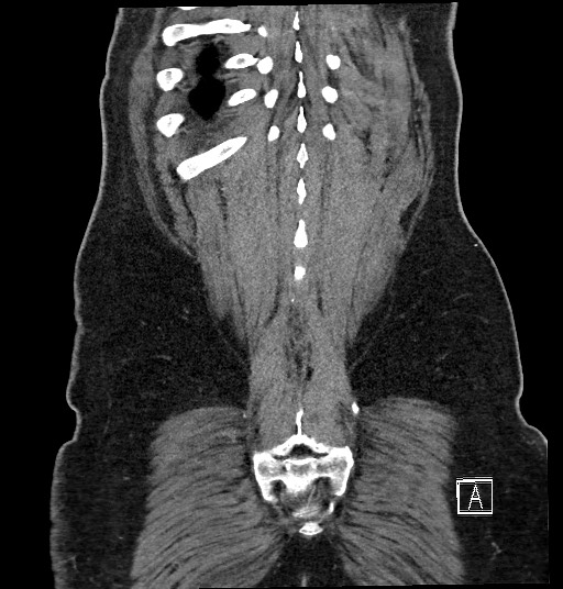 File:Closed loop obstruction - internal hernia into nephrectomy bed (Radiopaedia 59867-67320 B 131).jpg