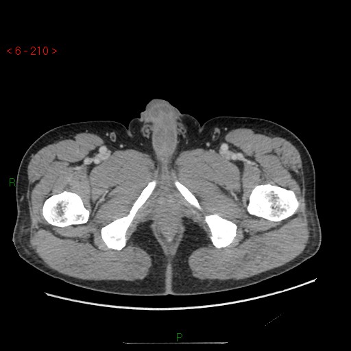 File:Closed loop obstruction and appendicular stump mucocele (Radiopaedia 54014-60163 A 128).jpg